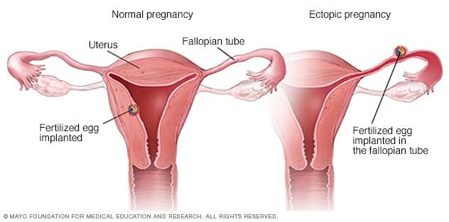 ectopic pregnancy
